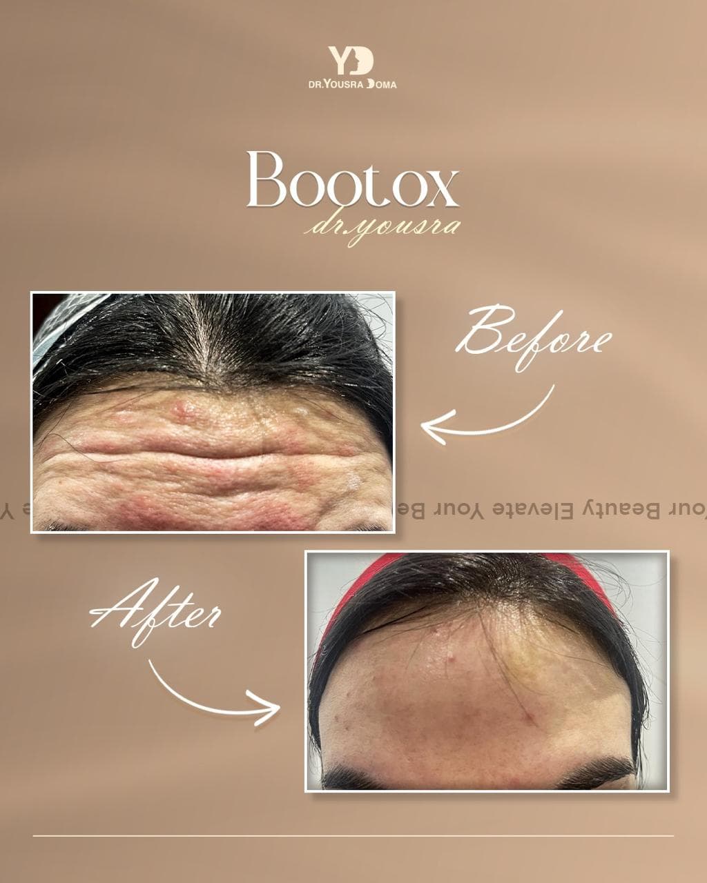 Allergan Botox (US) + before and after