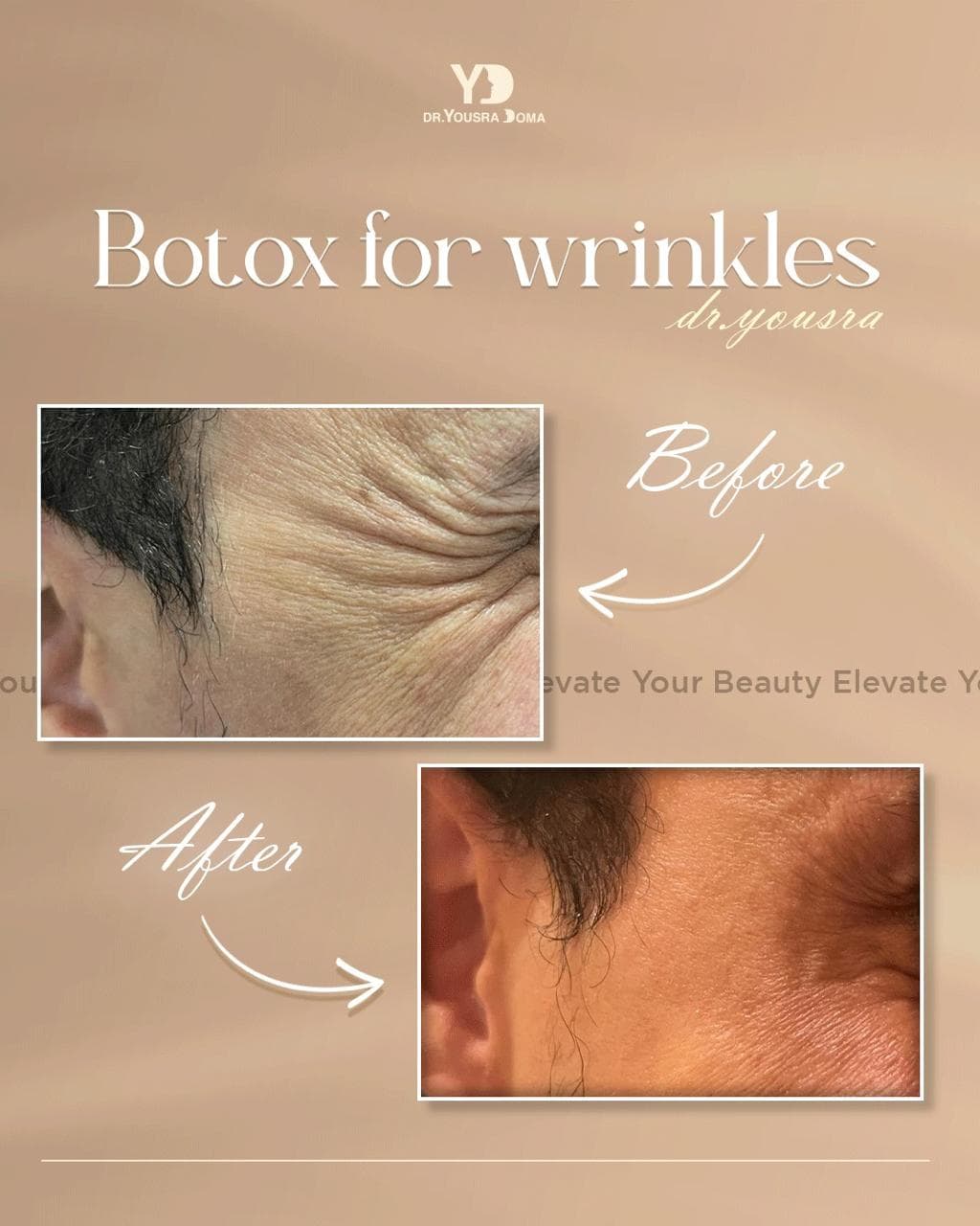 Allergan Botox (US) + before and after