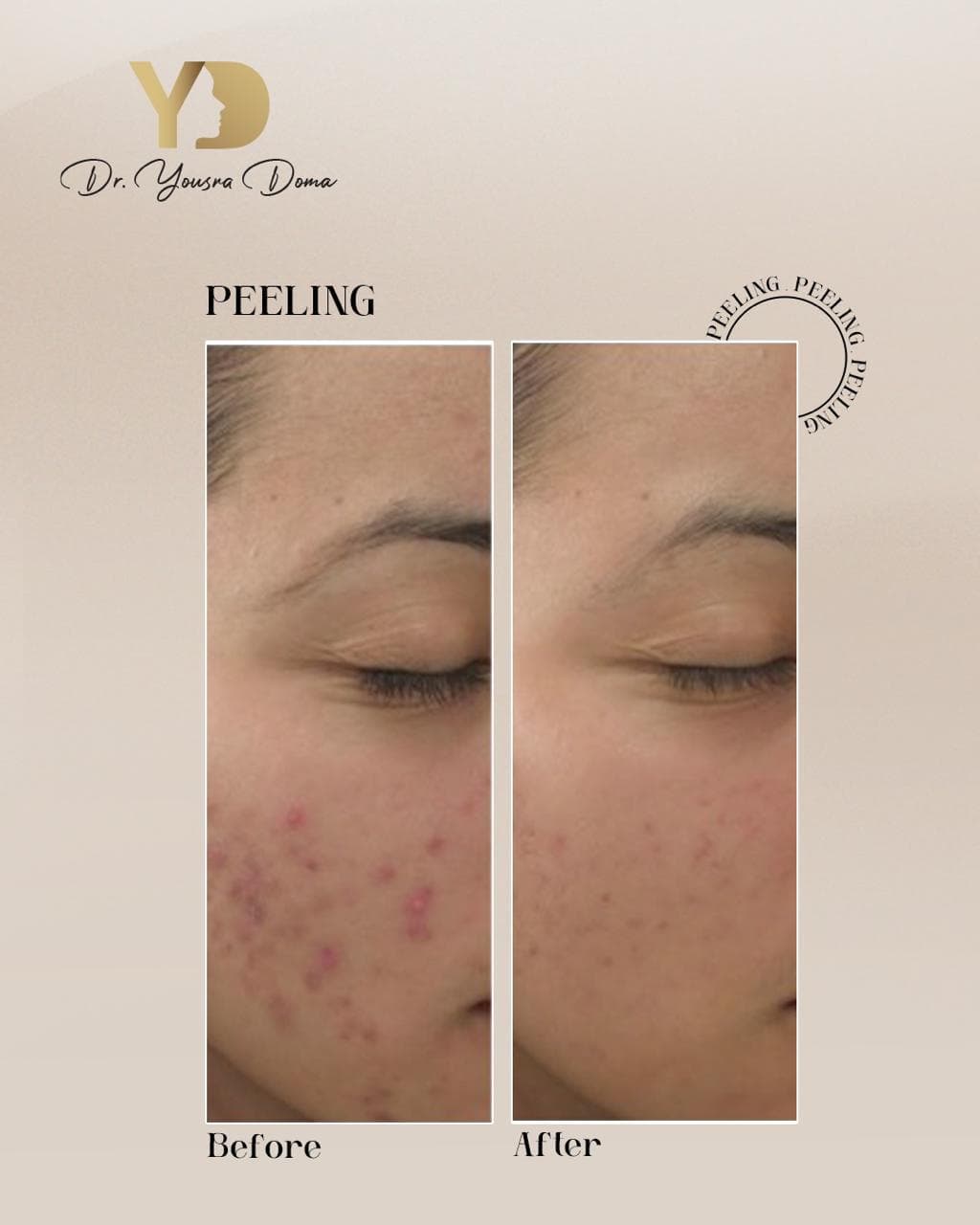 Cosmelan cold peel + before and after
