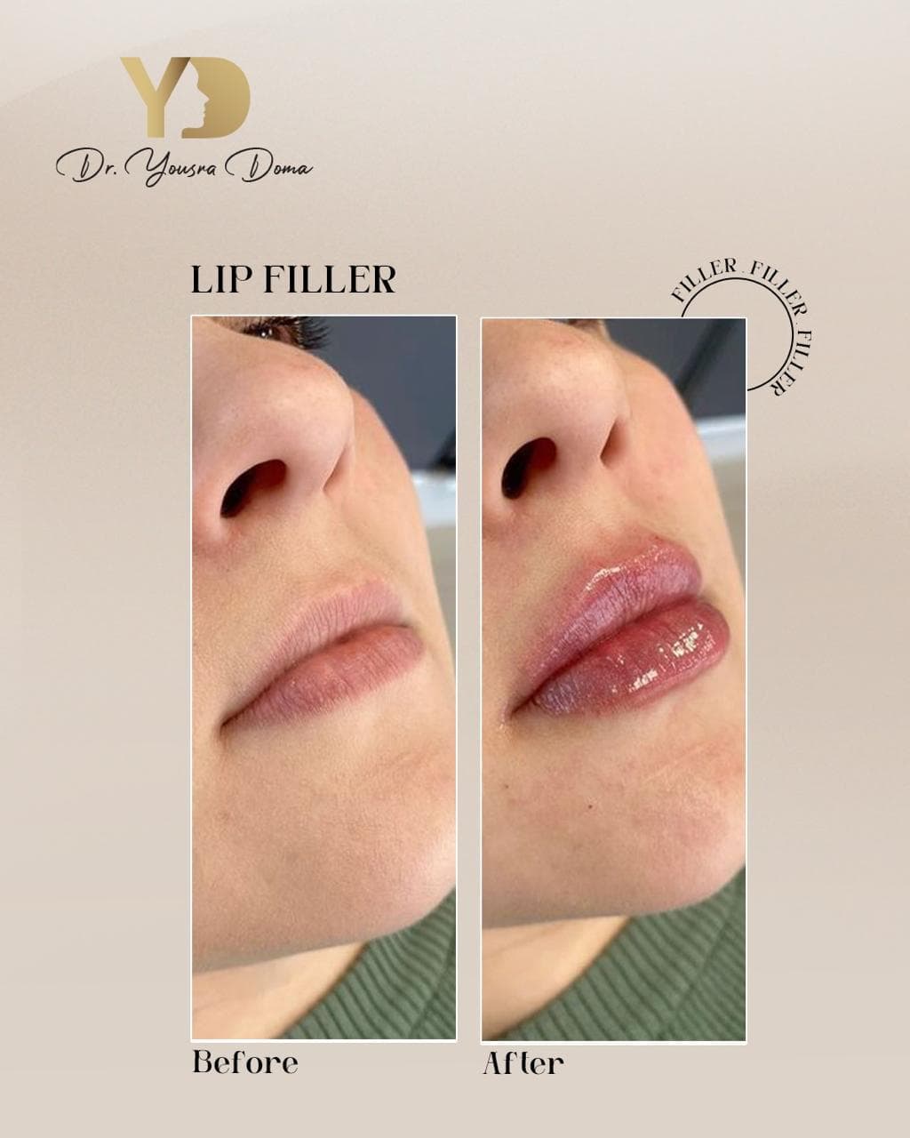 Juvederm filler + before and after