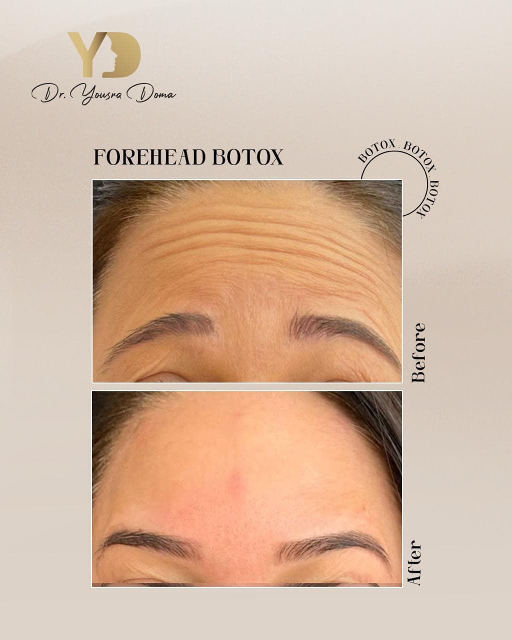 Allergan Botox (US) + before and after