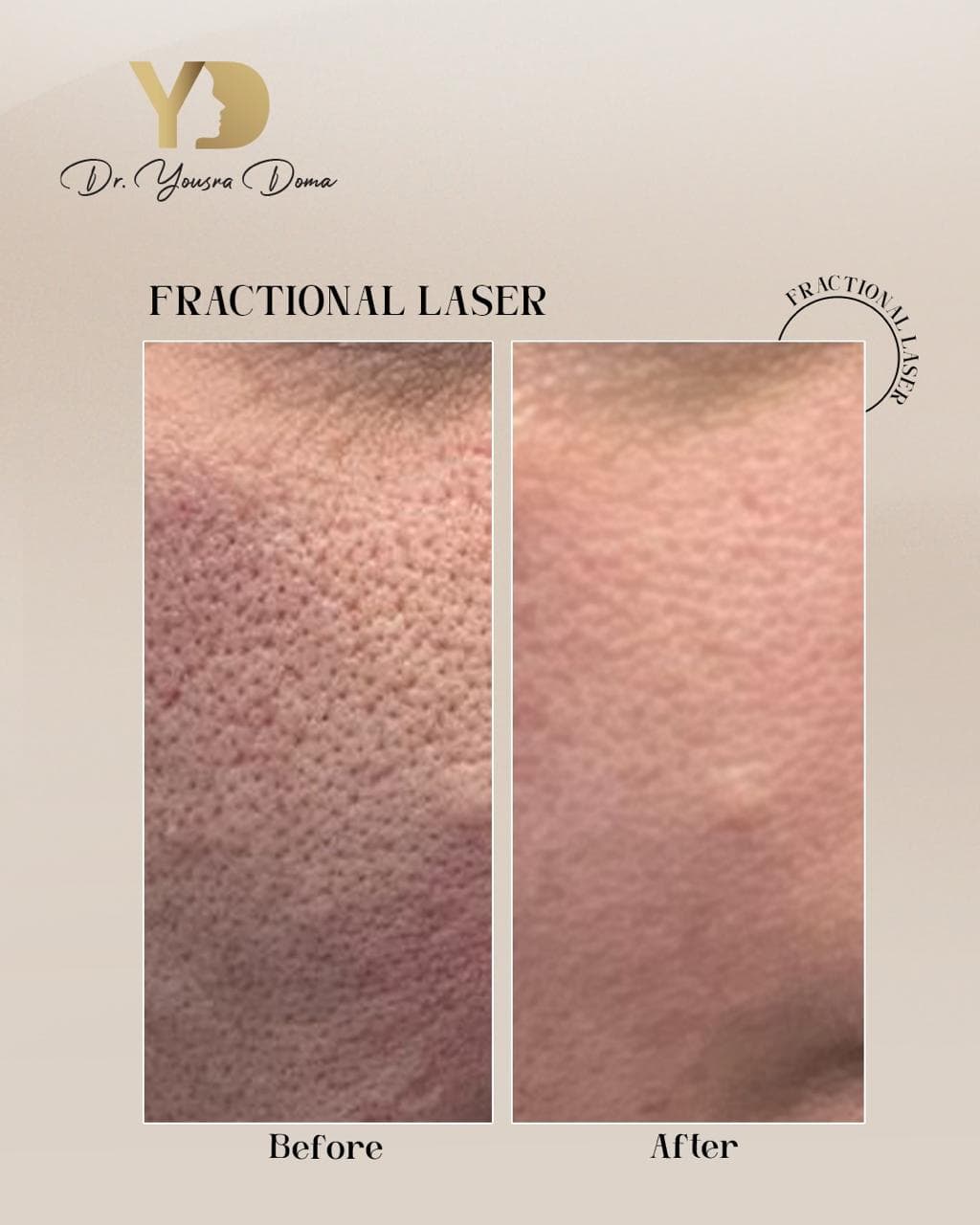 Fractional laser + before and after