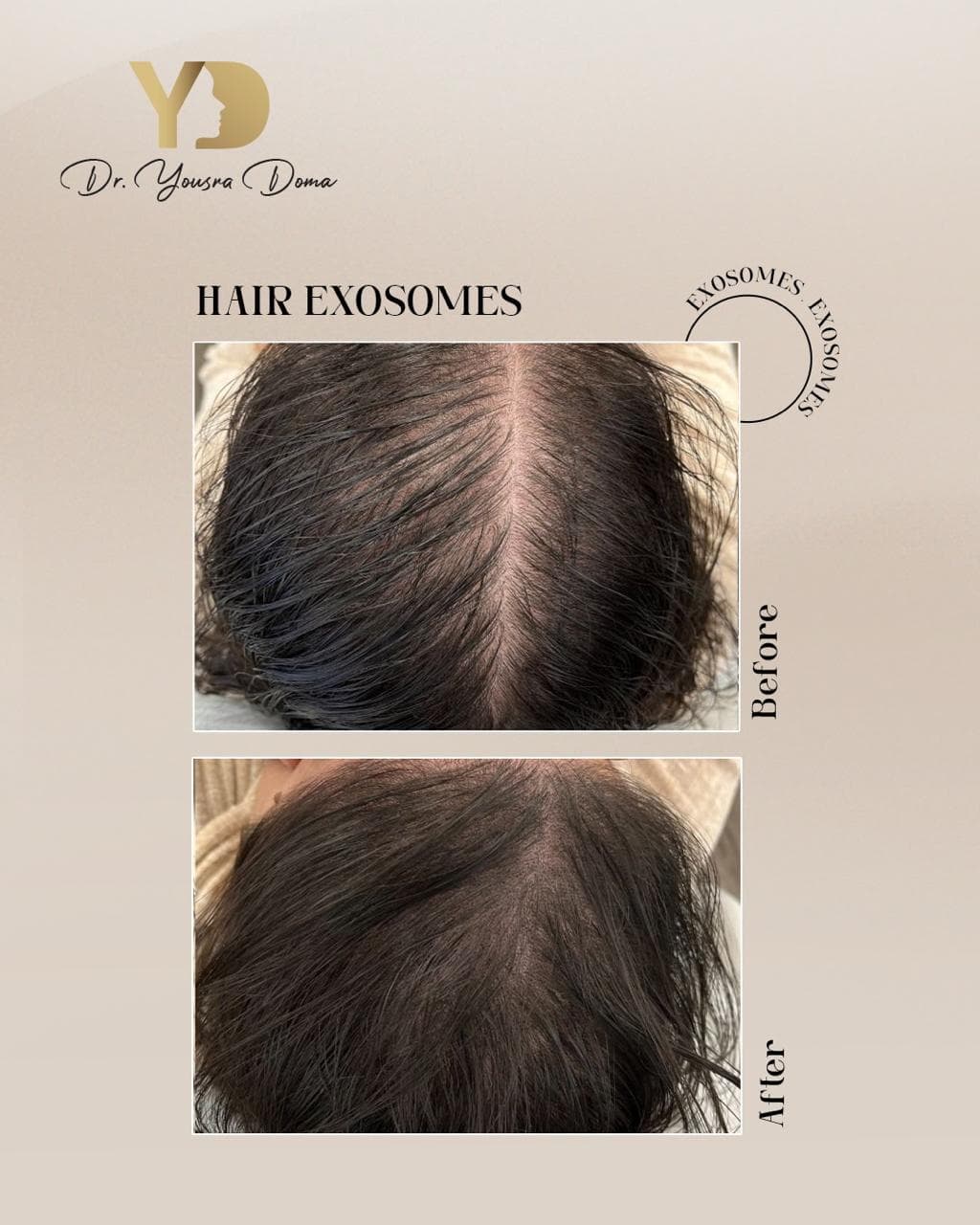 Hair exosomes + before and after