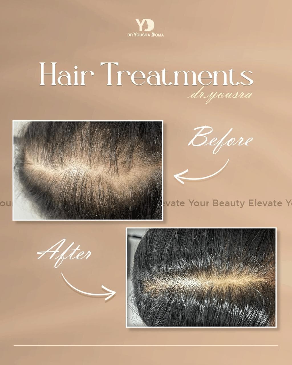 Hair plasma (PRP) + before and after
