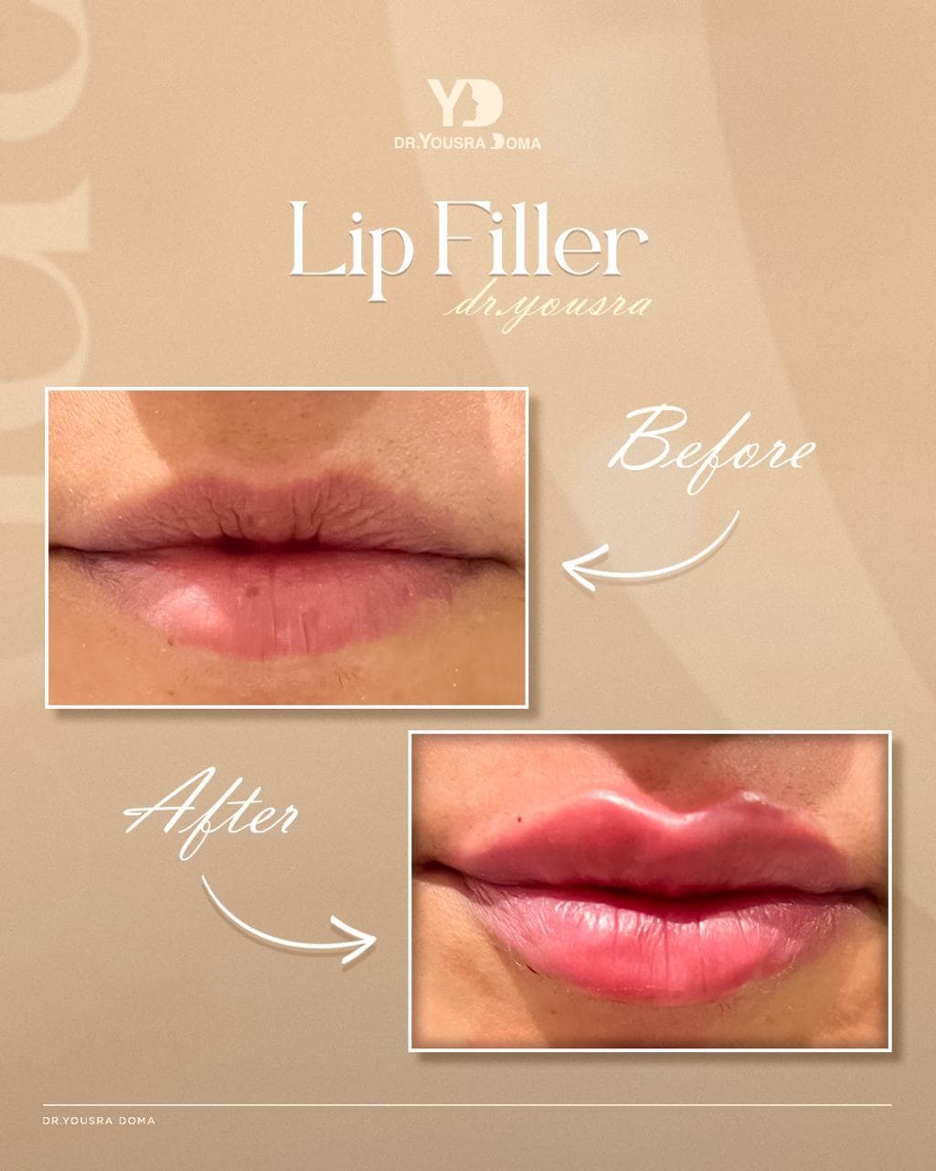Juvederm filler + before and after