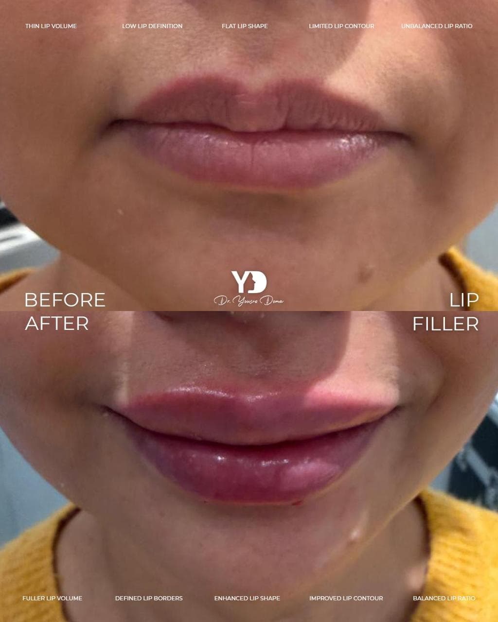 Juvederm filler + before and after